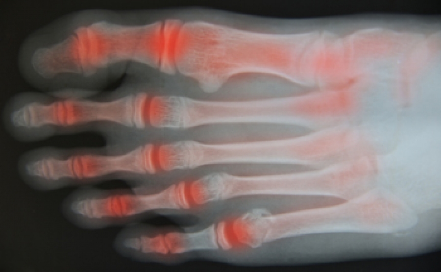 Types And Symptoms Of Foot Arthritis